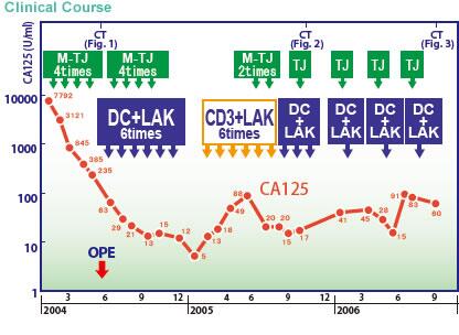 日本免疫細胞治療(瀨田診所)：卵巢癌，女，51歲