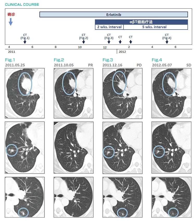 厄洛替尼耐藥后,免疫細胞治療(αβT細胞療法)治療后維持穩(wěn)定狀態(tài)的肺癌(IV期)案例