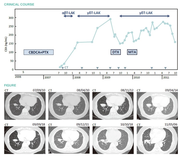αβT細(xì)胞治療抑制腫瘤進(jìn)展,γδT細(xì)胞治療維持長(zhǎng)期穩(wěn)定的肺腺癌案例