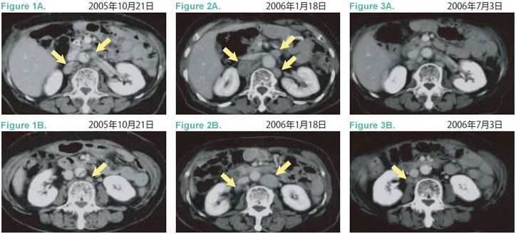 TS-1耐藥后經(jīng)免疫細(xì)胞療法治療后緩解的胃癌案例2