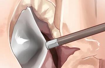 利用自體心包膜的主動脈瓣重建手術