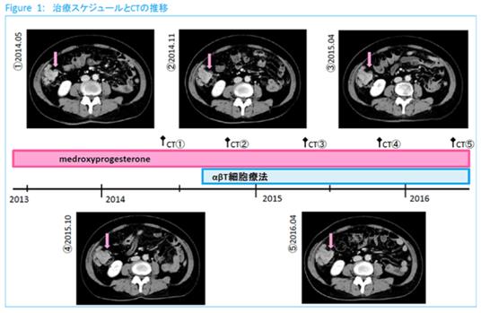 子宮內膜癌使用免疫細胞治療效果如何？